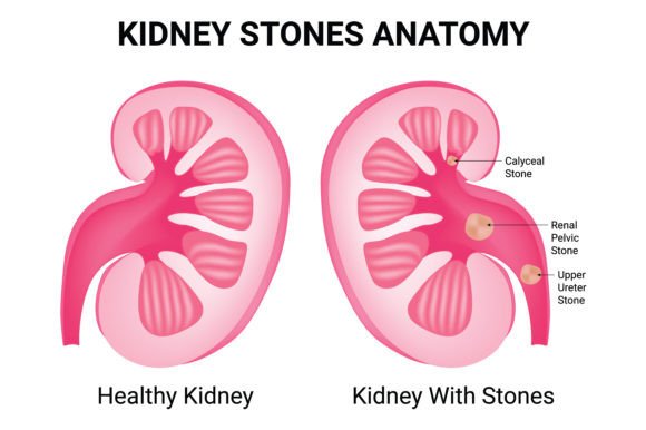 Download Kidney Stones Anatomy Science Design - Sign Collection
